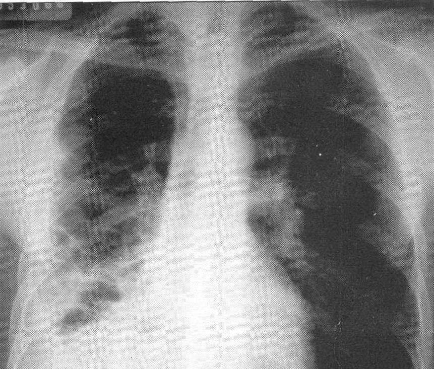 (图) 右肺多发性支气管肺囊肿